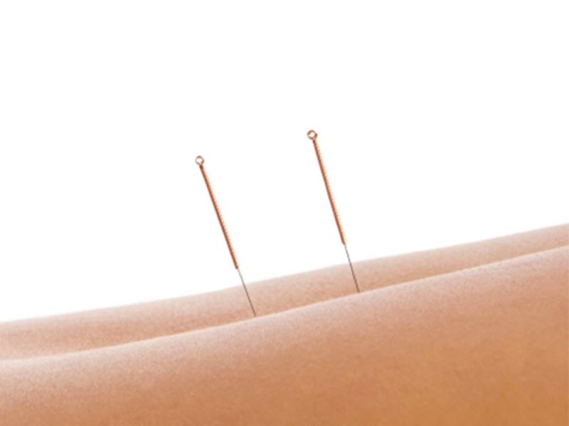 acupunctuurside acupunctuur nissewaard spijkenisse lutte qipong